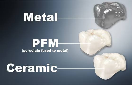molar-tooth-crown