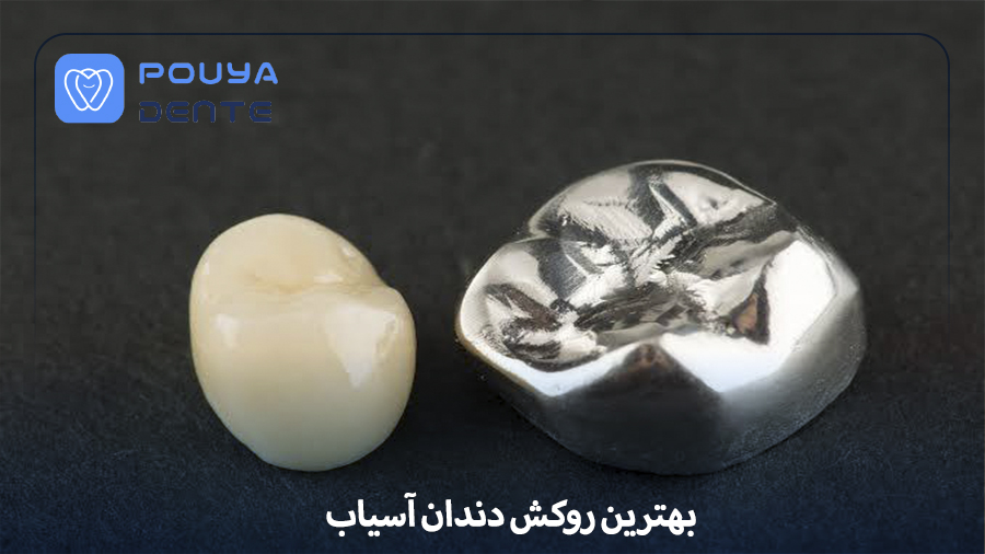 molar-tooth-crown