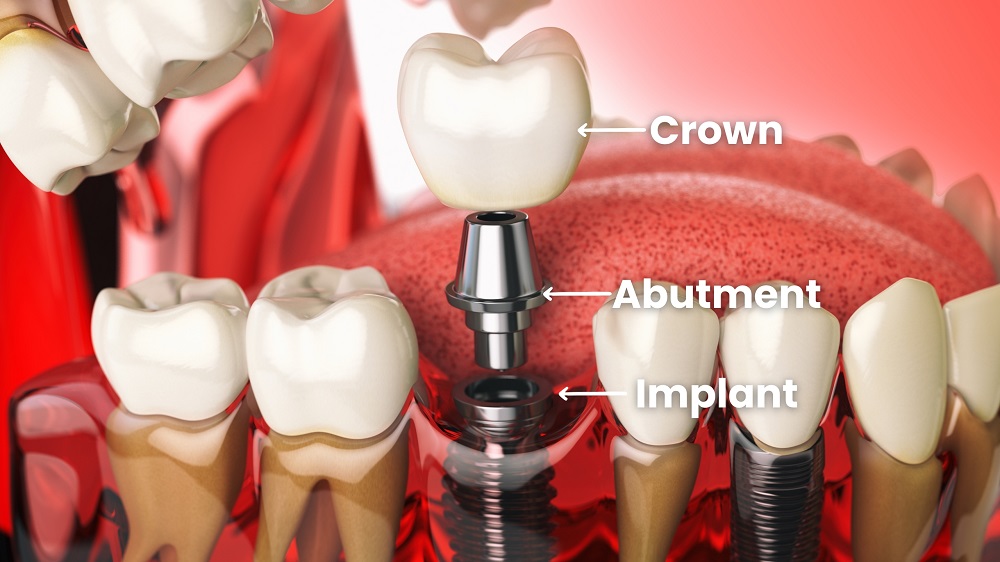 implant-terminology
