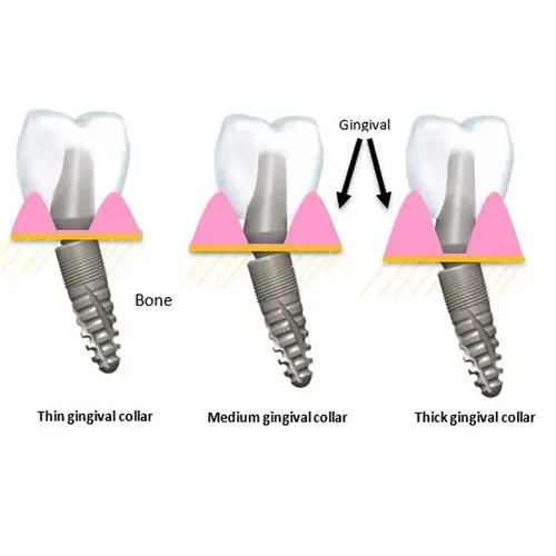 Angled implant