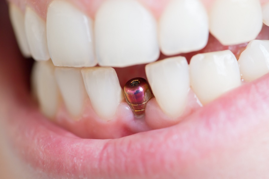 Bleeding after implant