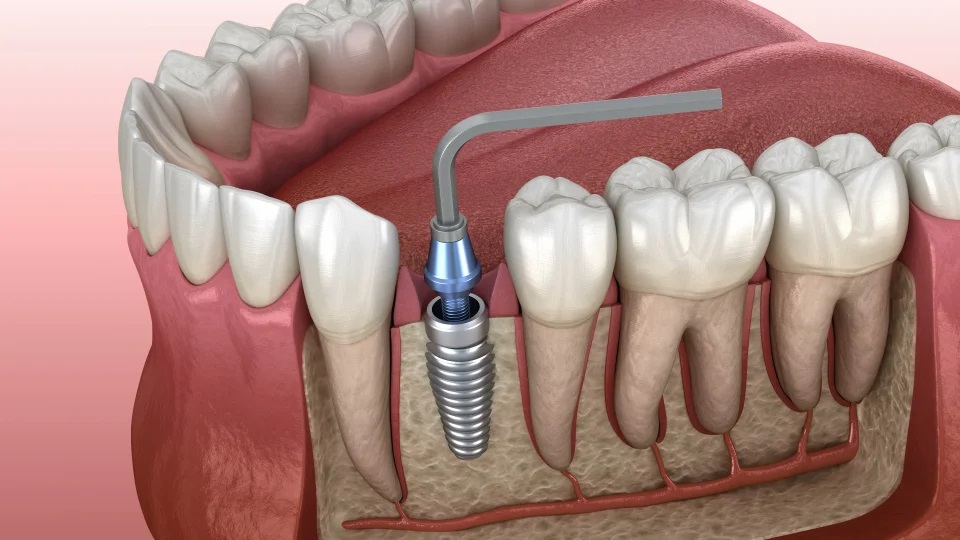Implant placement with anesthesia
