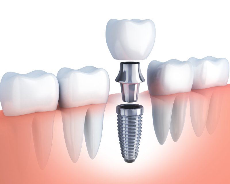 implant-terminology