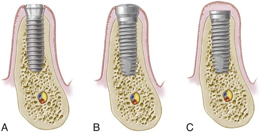 implant-terminology