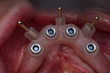 implant-terminology