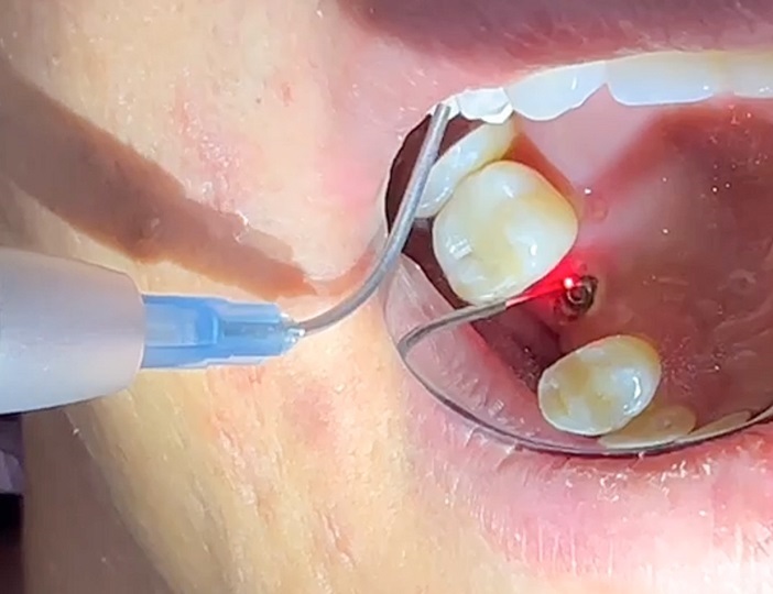 Laser-Assisted Dental Implant