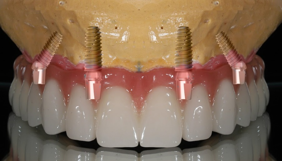 Angled implant