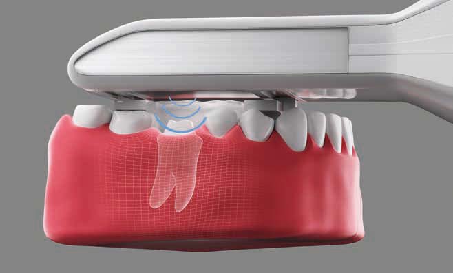 Polywave Light Cure