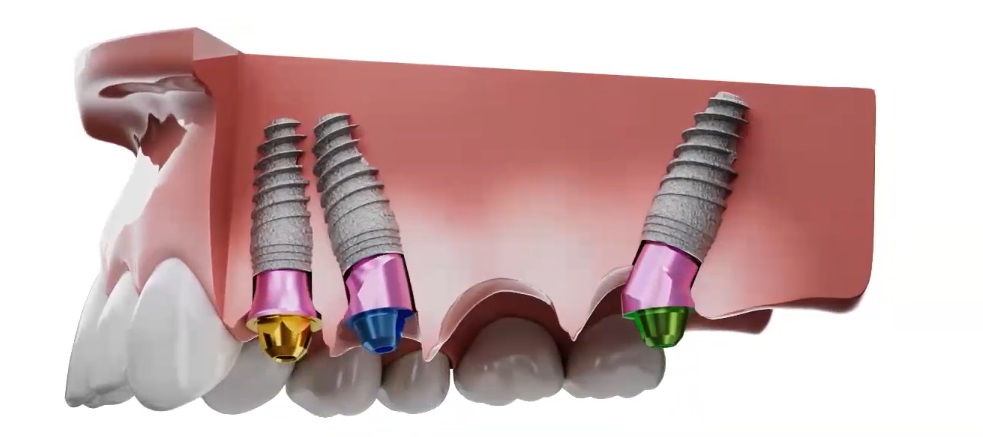 Angled implant