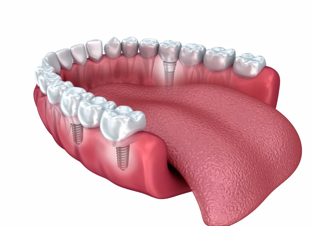 Implant placement with anesthesia