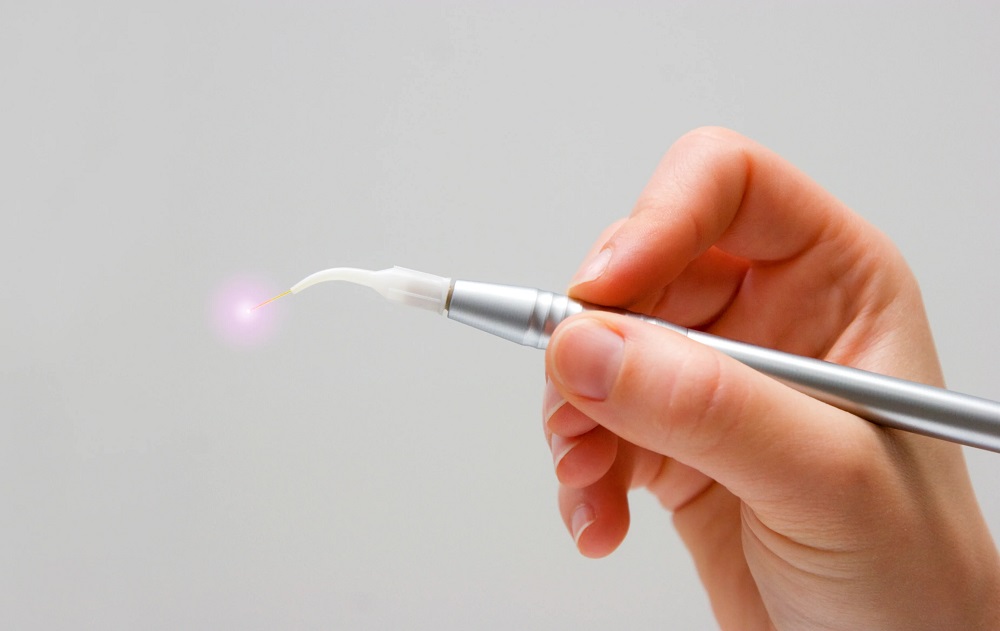 Laser-Assisted Dental Implant
