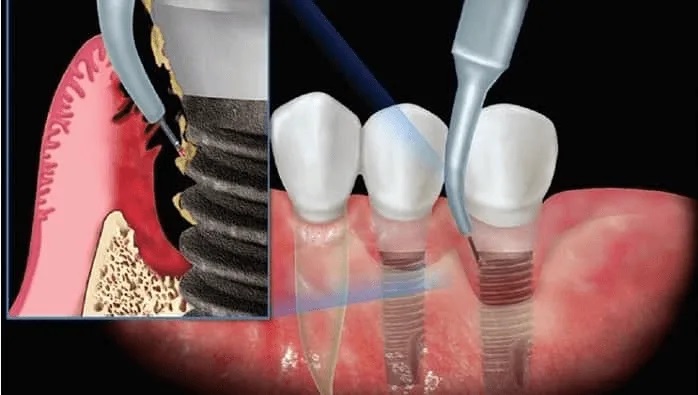 Laser-Assisted Dental Implant