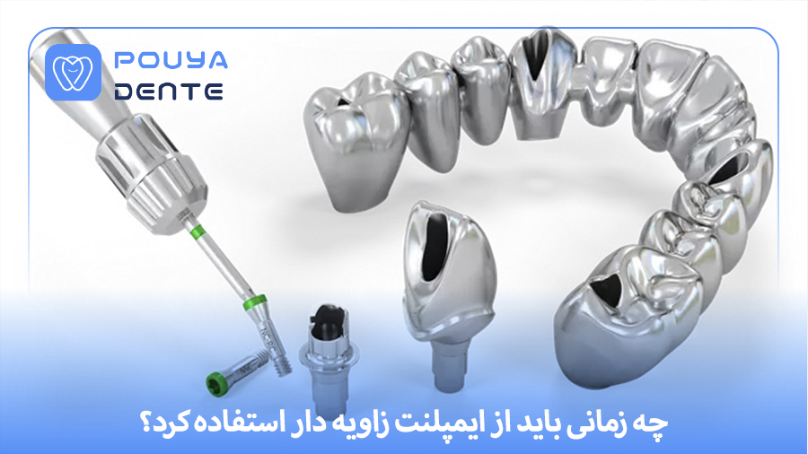 Angled implant