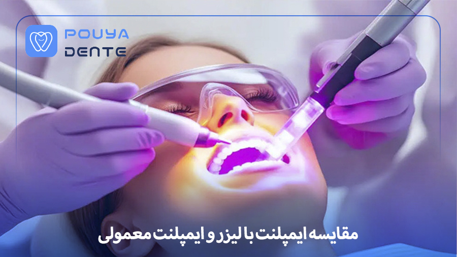 Laser-Assisted Dental Implant