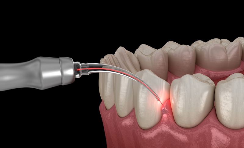 Laser-Assisted Dental Implant