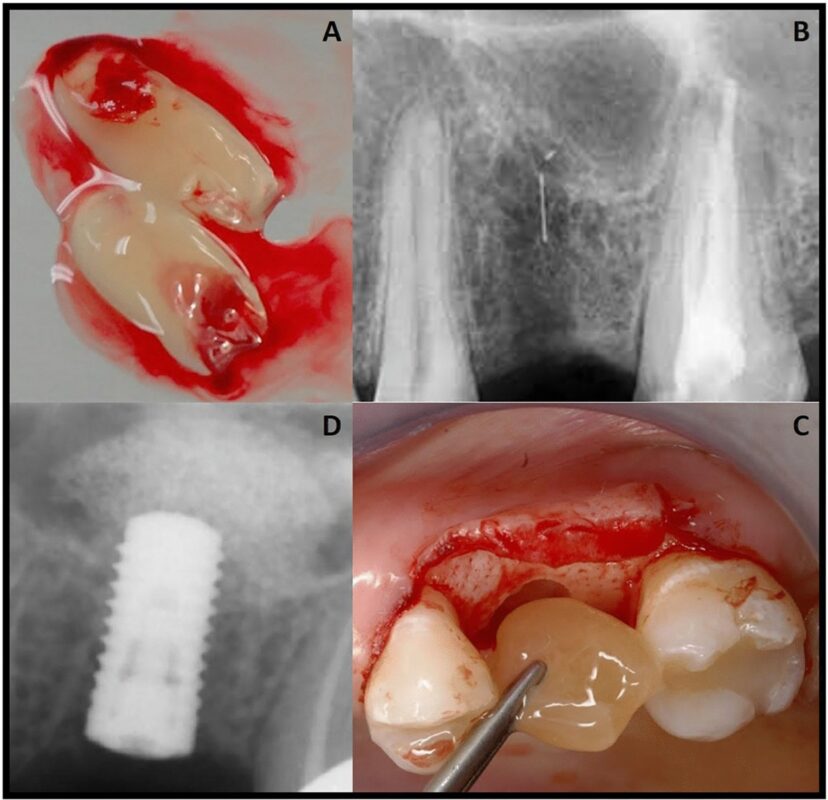 Comparison of PRF and PRP