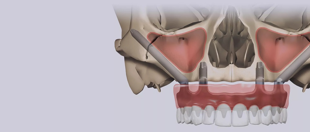 Zygomatic implant