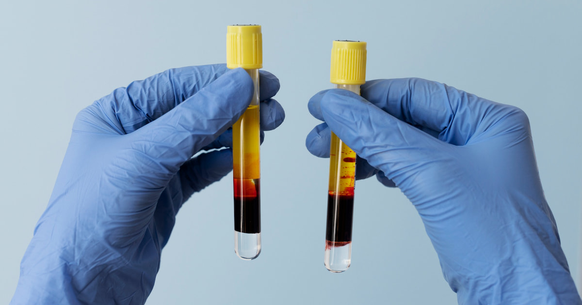 Comparison of PRF and PRP