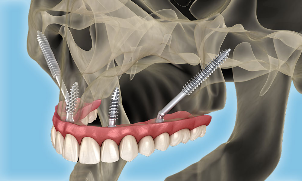 Zygomatic implant