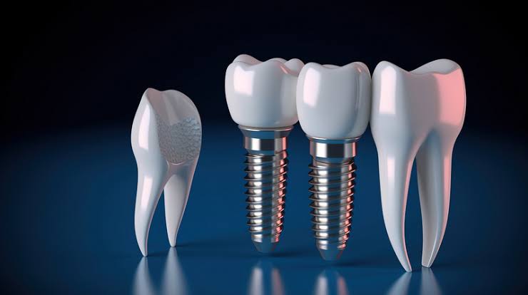 Allogeneic in implantology
