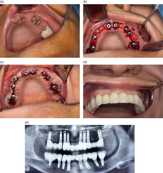 Allogeneic in implantology