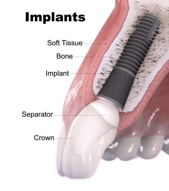 Immediate implant placement