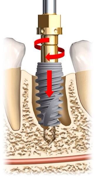 Immediate implant placement