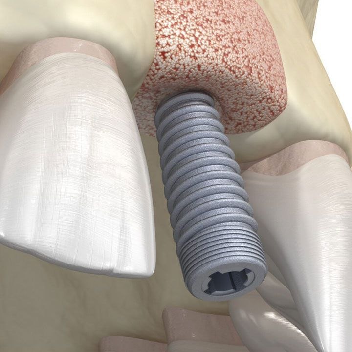 Immediate implant placement