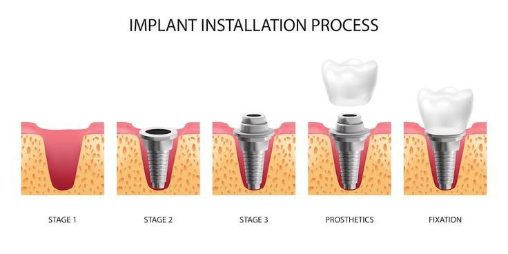 Immediate implant placement