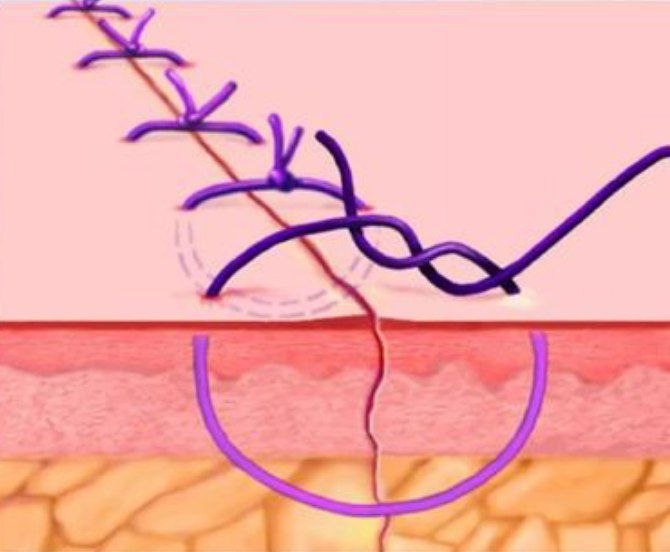 Soft tissue in implants