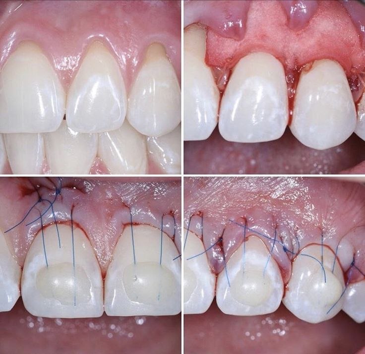 Soft tissue in implants