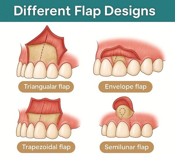 Soft tissue in implants