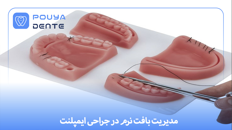 Soft tissue in implants