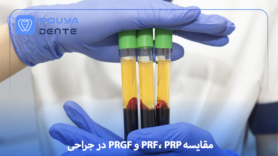 Comparison of PRF and PRP