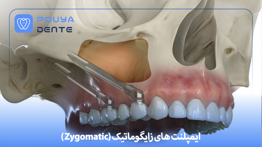 Zygomatic implant