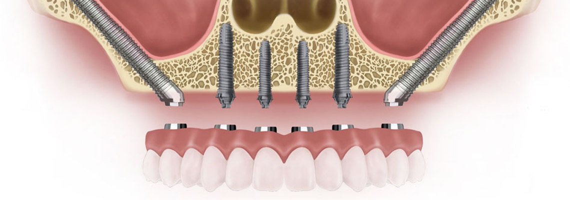Zygomatic implant
