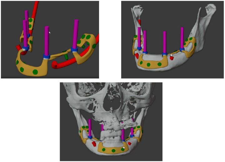 Repair of a loose implant
