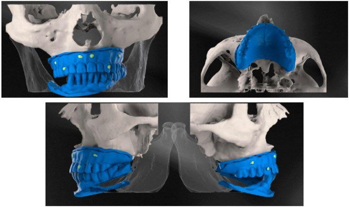 Repair of a loose implant