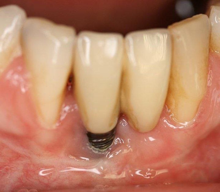 Implant removal