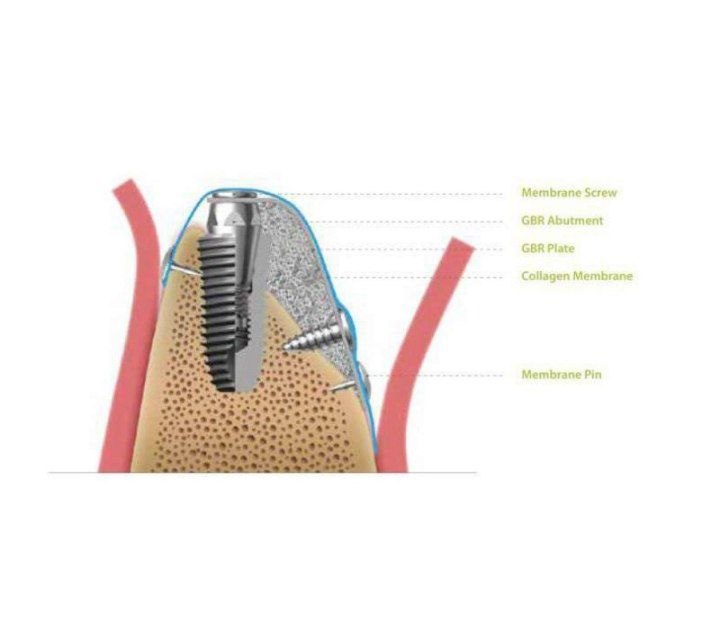 Implant removal