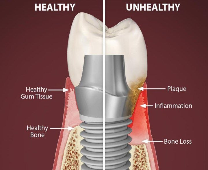Implant removal