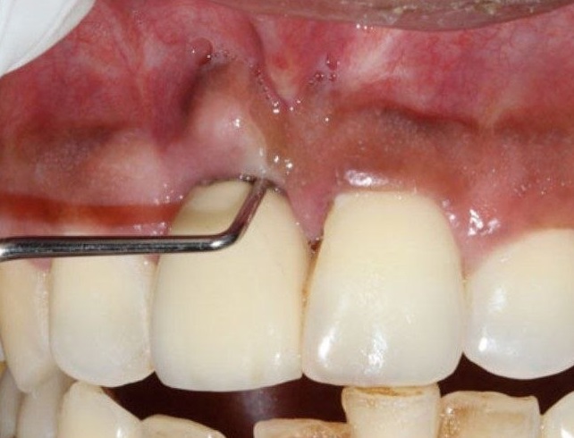 Implant removal
