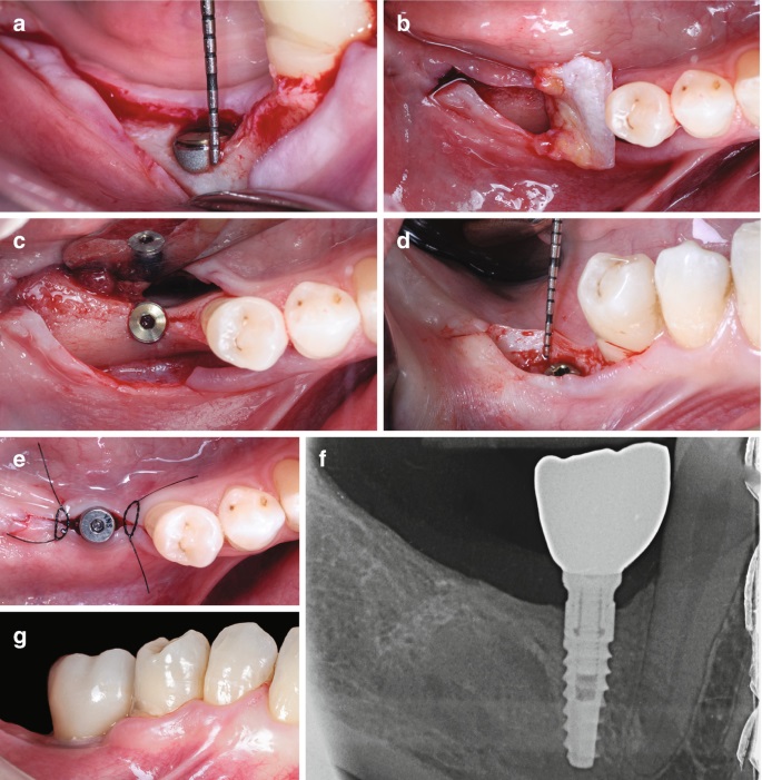 Microscopic implant surgery