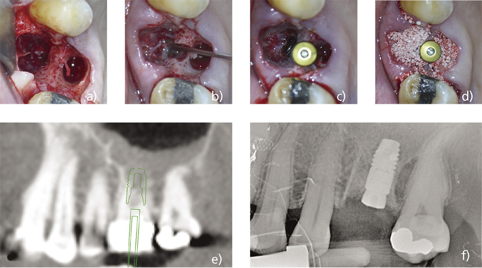 Microscopic implant surgery