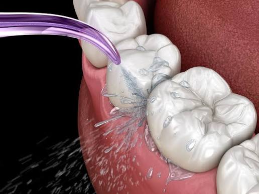 Implant cleaning