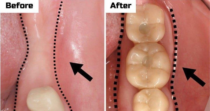 Minimum buccal bone thickness