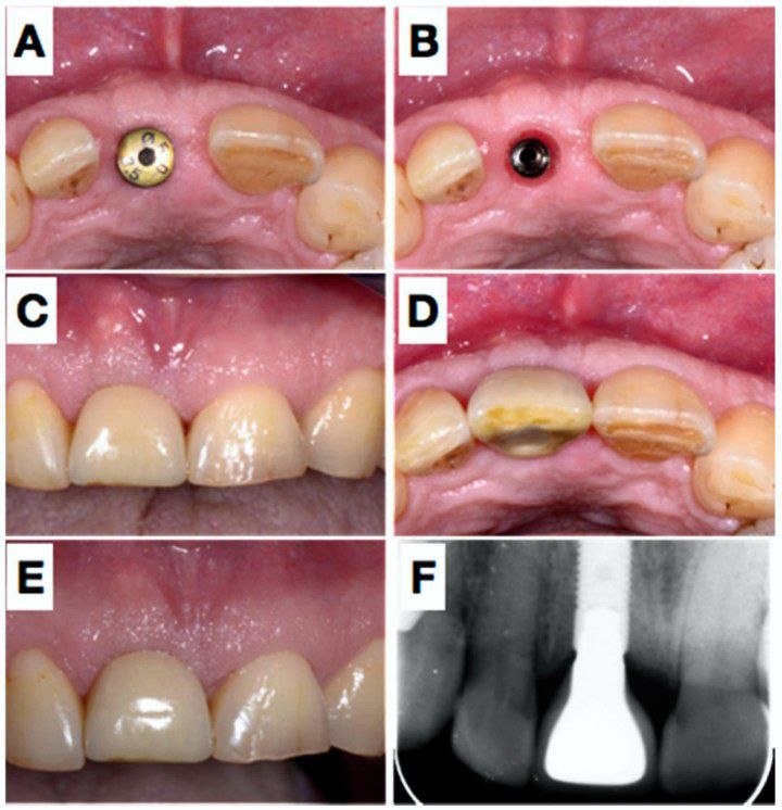 Minimum buccal bone thickness