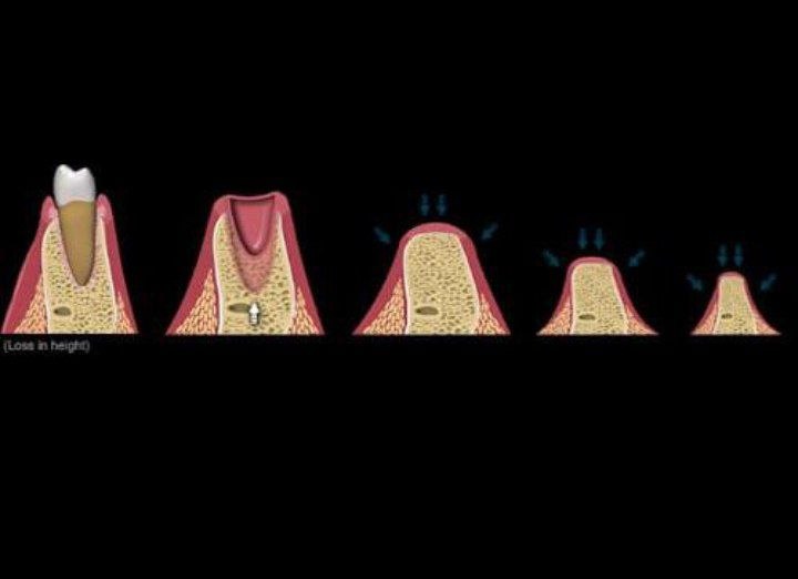 Minimum buccal bone thickness