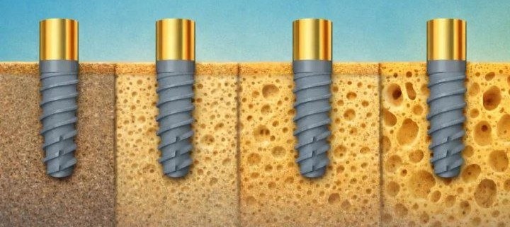 Endostyle implant