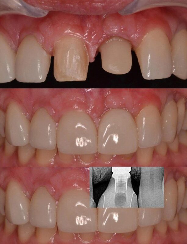 Endostyle implant